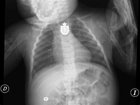 Radiografía mostrando un cuerpo extraño en el esófago