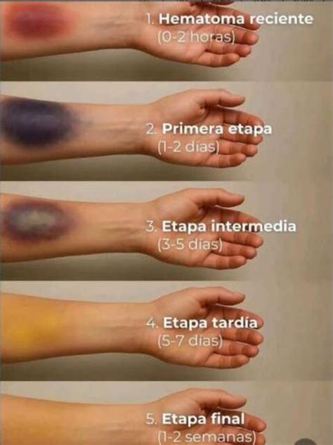 Esquema de la formación de un hematoma bajo la piel
