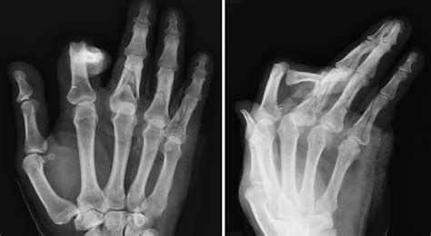 Radiografía de un dedo fracturado