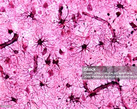 Micrografía de tejido nervioso mostrando desmielinización