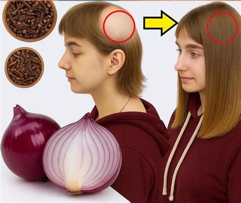 Mujer aplicando un tónico capilar de cebolla en su cuero cabelludo, con una cebolla y otros ingredientes naturales en el fondo.