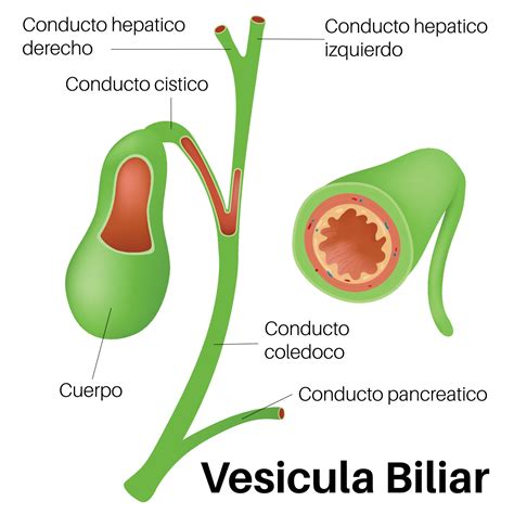 Esquema de la vesícula biliar y los conductos biliares con la formación de cálculos