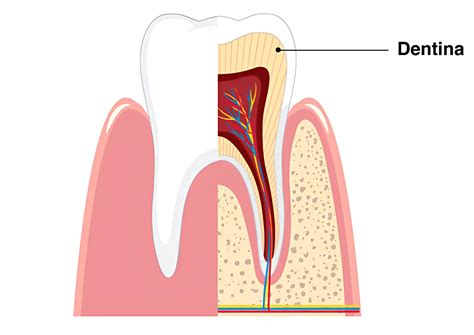 Diagrama de un diente mostrando esmalte, dentina y nervio, con flechas indicando la exposición de la dentina