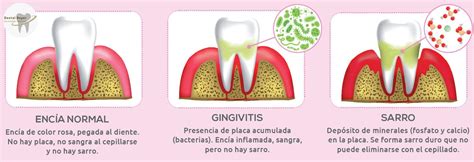 Esquema de la formación del sarro dental en los dientes