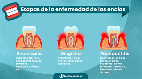 Ilustración de encías con gingivitis y periodontitis debido al sarro