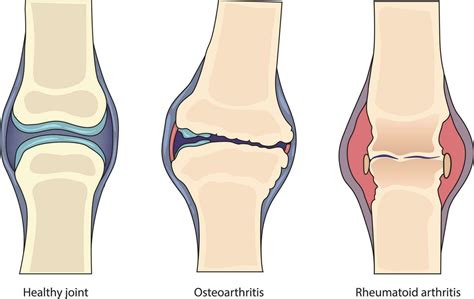 Ilustración de articulación afectada por artritis