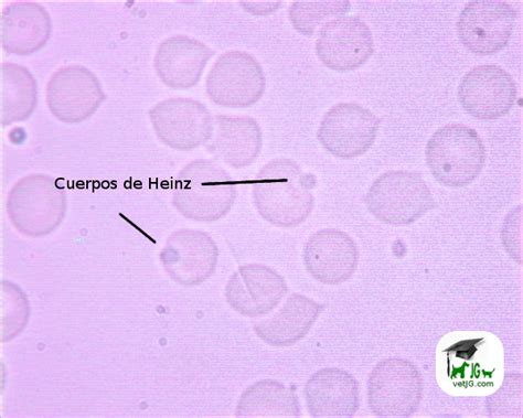 Representación esquemática de un eritrocito con cuerpos de Heinz y hemoglobina oxidada