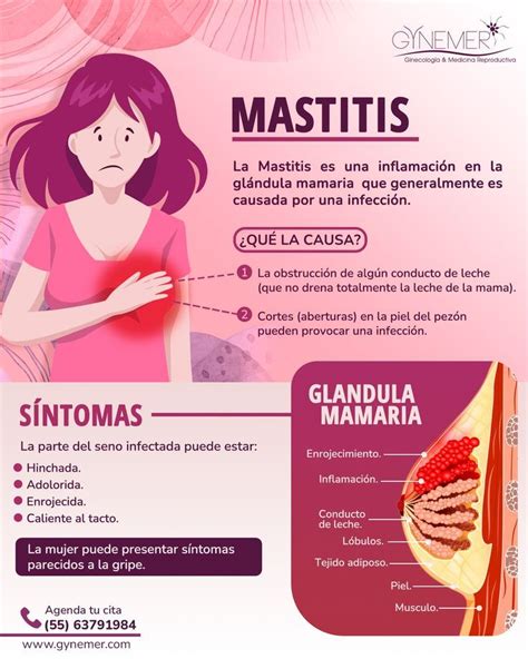Infografía ilustrativa de los síntomas de la mastitis: enrojecimiento, hinchazón, dolor y fiebre