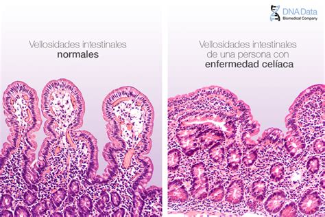 Esquema de intestino delgado sano y con vellosidades dañadas por la enfermedad celíaca