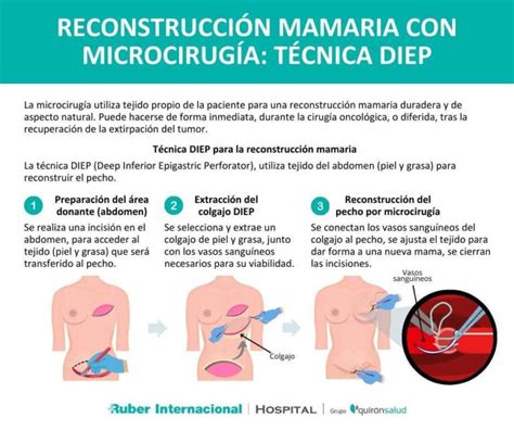 infografía detallando los pasos de una mastectomía y reconstrucción mamaria