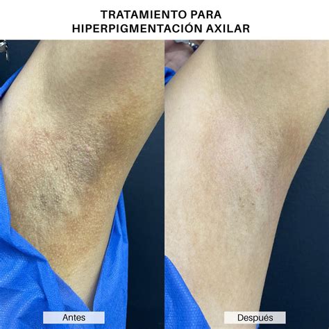 Ilustración de axilas con tono oscuro y factores que contribuyen a la hiperpigmentación.