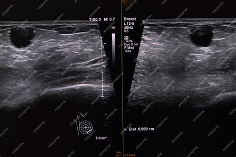 Equipo de ultrasonido mostrando una imagen de tejido mamario