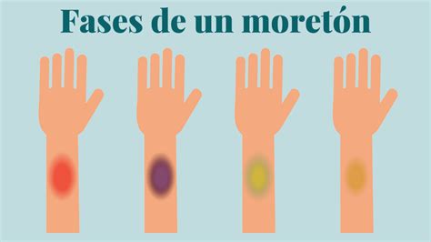 Ilustración mostrando la evolución del color de un moretón.