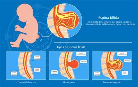 Ilustración de un feto con espina bífida comparado con un feto sano
