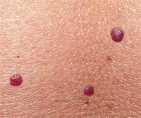 primer plano de puntos rubí o angiomas en la piel