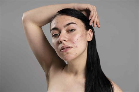 Imagen de una mujer con piel clara y otra con piel con acné para representar el contraste