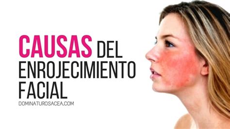 Esquema de las causas de enrojecimiento facial al comer alimentos como el queso