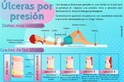 Esquema de la aparición de úlceras por presión en prominencias óseas de un paciente encamado