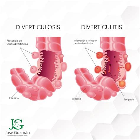 Esquema del colon mostrando divertículos y un divertículo inflamado (diverticulitis)