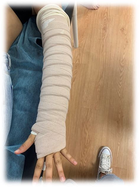 Imagen de una extremidad con vendaje multicapa para linfedema.