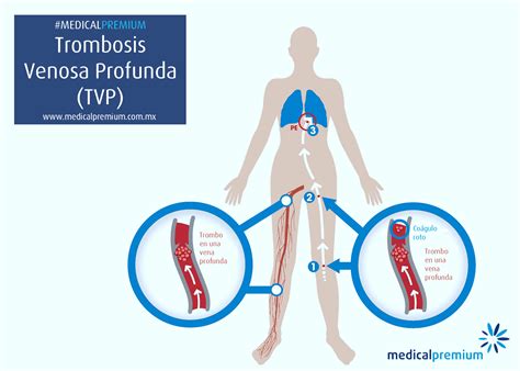 Diagrama de formación de trombosis venosa profunda y embolia pulmonar