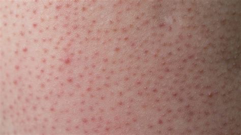 Foto cercana de piel con queratosis pilaris, mostrando los pequeños bultos ásperos.
