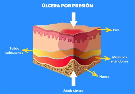 Esquema de formación de una úlcera por presión