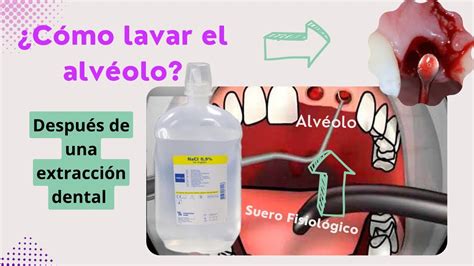 Esquema de una extracción dental con el alvéolo
