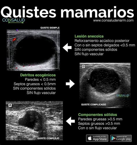 Esquema de un quiste mamario simple y uno complejo