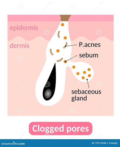Esquema de la piel con poros obstruidos y después de la exfoliación