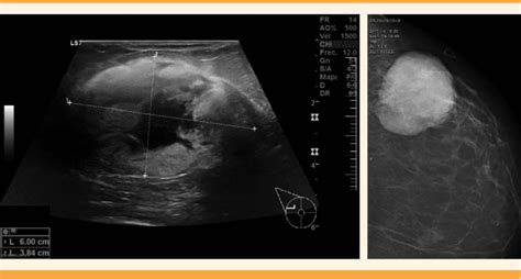 Imagen de ecografía mamaria mostrando tejido glandular.