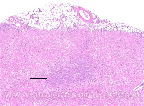 Histología de corazón de salmón (Oncorhynchus kisutch) afectado por HSMI