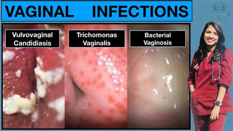 Foto de candidiasis vaginal con hinchazón y enrojecimiento