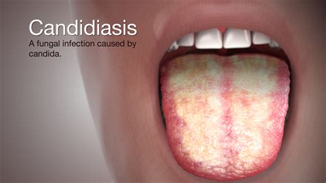 Foto de candidiasis oral mostrando placas blancas cremosas