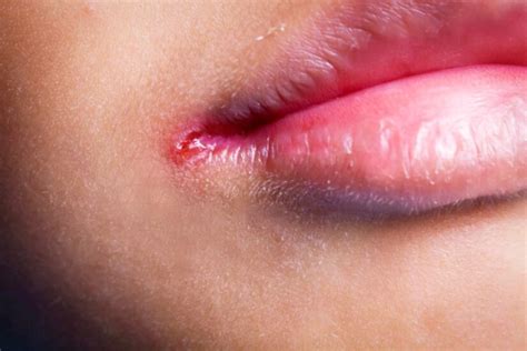 Foto de queilitis angular causada por infección de Candida