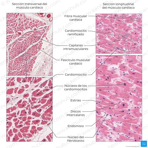 Imagen histológica comparativa de músculo de pollo normal (izquierda), uno con pecho de madera (centro) y uno con carne de espagueti (derecha) en una tinción de colágeno (rojo). Se observa el perimisio (p), fibra muscular (m) y fibra muscular degenerada (m-n).