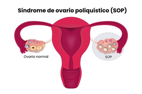 Esquema de las causas y factores contribuyentes al Síndrome de Ovario Poliquístico