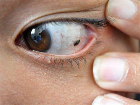 Ejemplo de nevus conjuntival benigno en el ojo