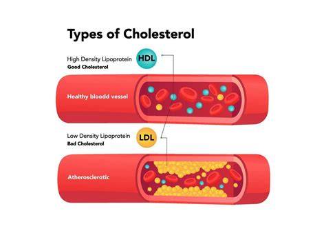 Gráfico explicando los tipos de colesterol (LDL y HDL) y su relación con la salud cardíaca
