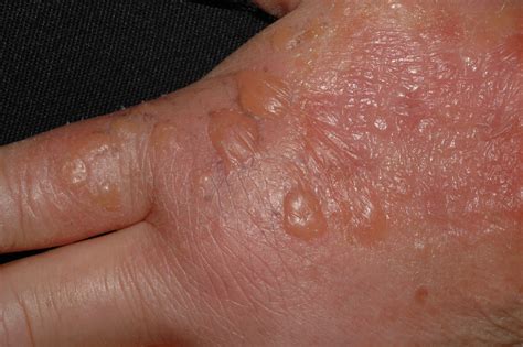 Ilustración de dermatitis por contacto en las manos con eritema y vesículas.