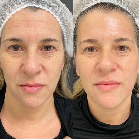 Foto de antes y después de piel con beneficios de vinagre de manzana
