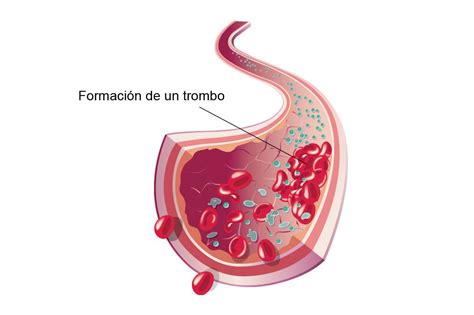 Esquema de la formación de un trombo y una embolia pulmonar, junto con métodos de prevención como medias de compresión y administración de anticoagulantes