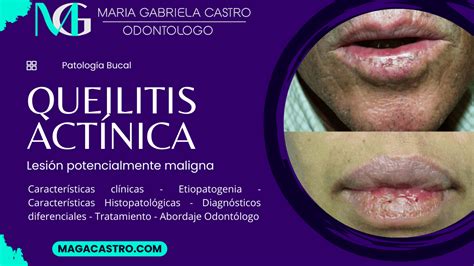 Ilustración mostrando diferentes tipos de queilitis: angular, actínica y exfoliativa.