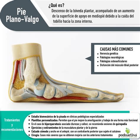 Imagen de un pie plano con la planta completamente apoyada