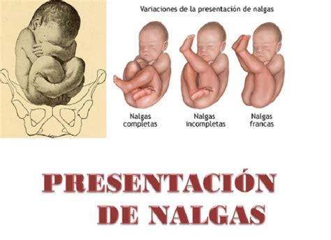 Diagrama: Bebé en presentación de nalgas completa