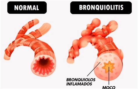 Ilustración médica que muestra los bronquiolos afectados por la bronquiolitis obliterante.