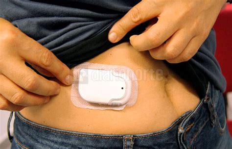 Foto de una bomba de insulina tipo parche de diseño discreto adherida al abdomen o brazo