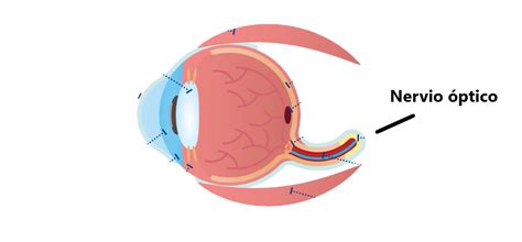 Ilustración médica mostrando el nervio óptico afectado por deficiencia de vitaminas