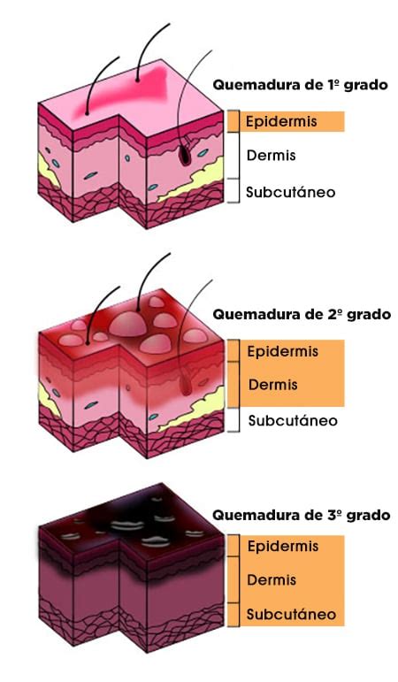 Esquema de las capas de la piel y los tipos de quemaduras según su profundidad