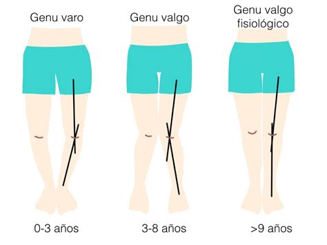 Esquema anatómico que compara unas piernas alineadas correctamente frente a una deformidad en genu varo (piernas arqueadas).